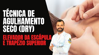 Agulhamento Seco Dry Needling no Trapézio Superior e Elevador da Escápula [upl. by Lavina831]