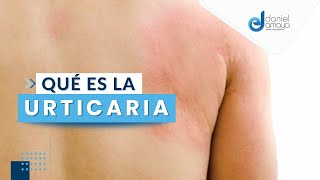 La Urticaria I Alergólogo en Medellín I Alergias en la piel [upl. by Enert]