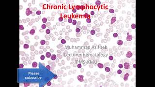 Chronic lymphocytic leukemia classification diagnosis and differential diagnosis in URDUHINDI [upl. by Dj156]