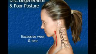 Cervical Disc Degeneration [upl. by Elfrida]