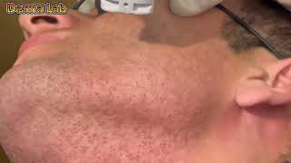 Permanent Hair removal treatment dermalab hairremoval dermatology skincare gentlelase gentlel [upl. by Stephie]