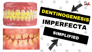 Dentinogenesis Imperfecta Simplified [upl. by Kinny]