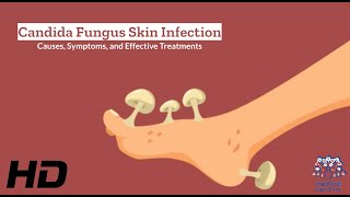 Candida Fungus Skin Infection Explained What You Need to Know [upl. by Nylkoorb319]