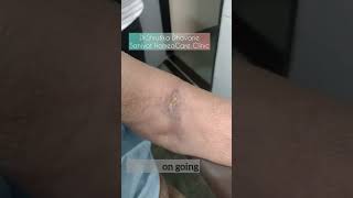 A case of Phlebitis Treated with Homeopathy  Case results drshrutikadhavane homeopathy [upl. by Llib240]