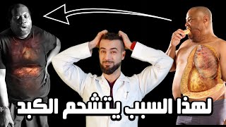 علاج سموم الكبد الدهني  شرح رائع لعلاج تشحم الكبد واعراضه بدون ادويه [upl. by Yneffit]