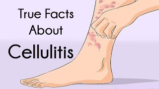 True Facts About Cellulitis [upl. by Asoj]