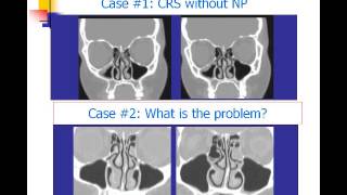 Chronic Rhinosinusitis Hamilos [upl. by Shanon]