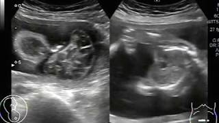 Ultrasound Video showing anencephaly with polyhydramnios [upl. by Brout]