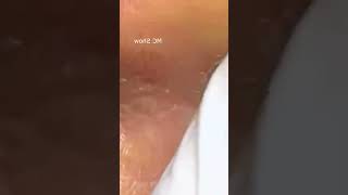 Pickel Ausdrücken Spa  Blackheads Akne amp Mitesser entfernen 🔴 33 [upl. by Clywd]