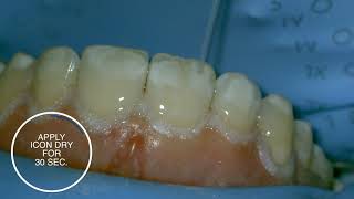 White spot treatment using infiltration with Icon  stepbystep [upl. by Ivz595]