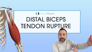 Distal Biceps Tendon Rupture  Expert Physio Review [upl. by Inami]