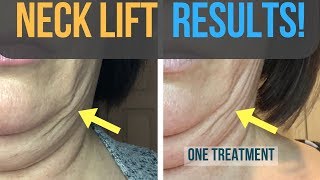 Results From My Fibroblast Plasma Neck Lift [upl. by Severson339]