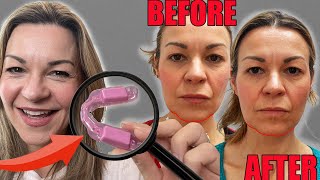 This device corrected my face shape and cured my jaw pain Oralift review [upl. by Nylasej87]