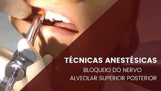 Técnicas anestésicas bloqueio do Nervo Alveolar Posterior [upl. by Sidwell197]