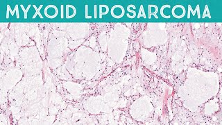 Myxoid liposarcoma high grade formerly round cell liposarcoma AIP France 2021 [upl. by Belda]