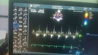 Global hypokinesia of lv severe lv severe TR moderate MR [upl. by Lachman]