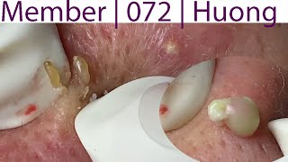 Acne Treatment Huong Da Nang 072  Member [upl. by Stinky112]