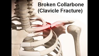 Broken Collarbone Clavicle Fracture [upl. by Dryfoos]