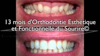 Sourire gingival adulte  correction en 13 mois par aligneurs® en OEFS© [upl. by Eeliab]