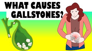 What Causes Gallstones Major Causes Of Gallstone Disease Gallstones Causes [upl. by Magel]