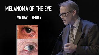 Mr David Verity  Melanoma of the eye [upl. by Laamak958]