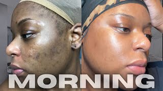 HOW I CLEARED MY HYPERPIGMENTATION AND DARK MARKS  MORNING SKINCARE ROUTINE [upl. by Oirramed401]