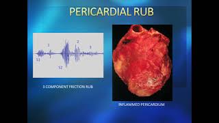 pericardial friction rub [upl. by Lemhar181]