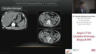 1 Angio CT for Complex Drainage Biopsy and RFA  Dr Nanda Venkatanarasimha [upl. by Hahsi]