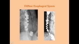 Esophageal Disorders old version with sound  CRASH Medical Review Series [upl. by Favata312]