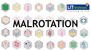 Malrotation [upl. by Nitas]