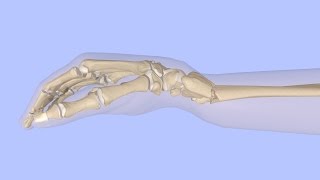 Closed Reduction of a Distal Radius Fracture [upl. by Otanutrof128]