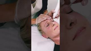 Non surgical eye lift treatment with Plasma Pen Fibroblast [upl. by Syst]