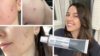 HOW I CLEARED MY SKIN IN 1 MONTH  Tretinoin Cream 0025 Before and After [upl. by Ejrog]