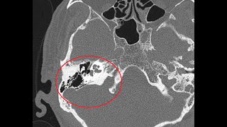 HRCT Temporal bone  A more detailed version  Basic to Advanced  AXIAL amp CORONAL VERSION 2 [upl. by Eelegna381]