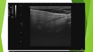 Echographie de la parotide le piège [upl. by Helali]