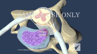 Cervical Disc Herniation [upl. by Eiddal]