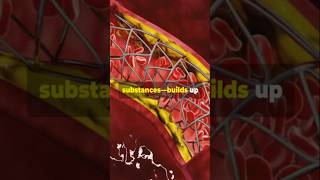 coronaryarterydisease cad Coronary Artery Disease Causes and Symptoms [upl. by Egamlat]