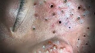 Toltal Best blackheads by Loan Nguyen No ads [upl. by Heng447]