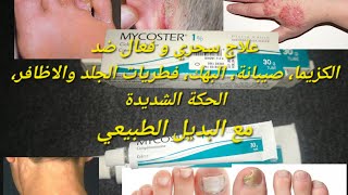 كريم فعال لعلاج فطريات الجلد والأظافر، كزيما، صيبانة، الحكة والبهك ميكوستر Mycoster 1 مع بديل طبيعي [upl. by Obediah503]