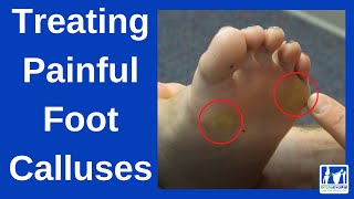 How to Treat Painful Foot Calluses [upl. by Erida]