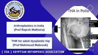 Arthroplasties in India Prof Rajesh Malhotra  THR for adult dysplastic hip Prof Mahmoud Mabrouk [upl. by Rebma]