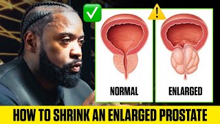 How to Shrink an enlarged Prostate [upl. by Ayomat302]