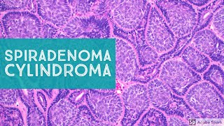 Spiradenoma amp CylindromaSweat Gland Tumor Pathology [upl. by Howlond752]