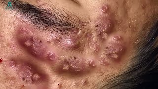 Big Cystic Acne Blackheads Extraction Blackheads amp Milia Whiteheads Removal Pimple Popping [upl. by Smiley]