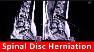 Spinal Disc Herniation in MRI scan by Radiology TV [upl. by Ledairam741]