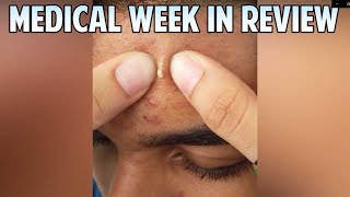 Scalp Cysts Pimple Popping Popaholics and Whitehead Removal Big Pops [upl. by Chryste]