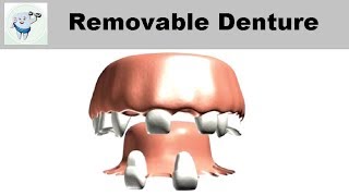 Removable Partial Denture Animation [upl. by Eudoxia671]