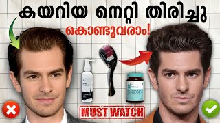 Receding hairline Re Grow your hair In 2 Methods Malayalam 🔱🔥 [upl. by Eiahpets303]