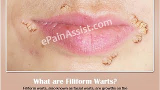 Filiform Warts Causes Symptoms and Treatment [upl. by Ardnama886]