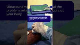 Endovenous Laser Ablation  NonSurgical Varicose Veins Treatment at The Vein Institute shortsvideo [upl. by Lamiv]